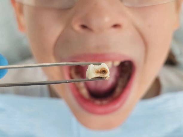 Best Emergency Dentist for Lost Fillings or Crowns in Cicero, IN